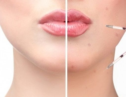 Awas! Jangan Sembarang Obati Jerawat!