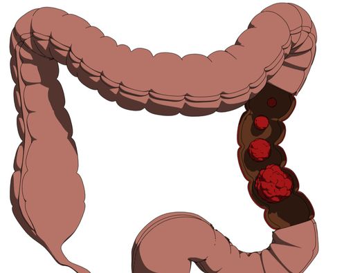 Deteksi Dini Cegah Peluang Kena Kanker Usus Besar