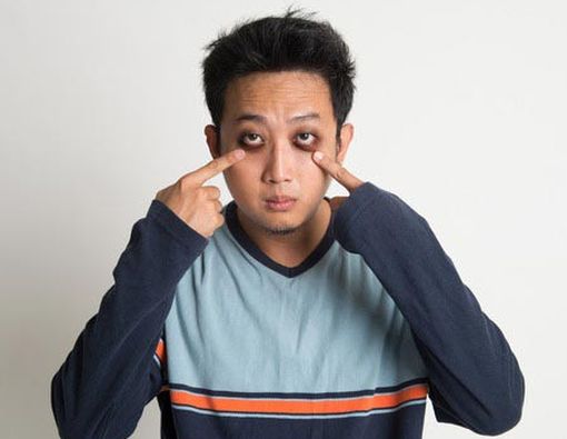 Penyebab Muncul Lingkaran Hitam di Sekeliling Mata