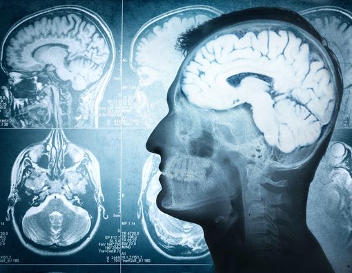 Korupsi Massal, Indikasi Gangguan Otak?