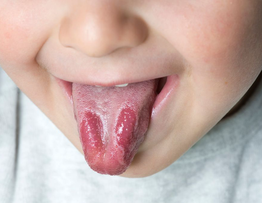 Geographic Tongue