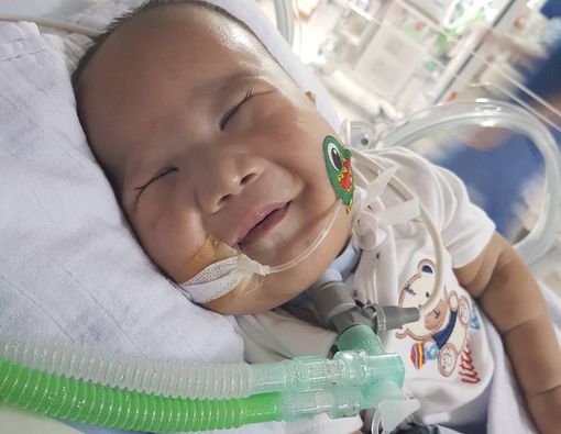 Penyebab Trisomi 13, Penyakit yang Diderita Adam Fabumi