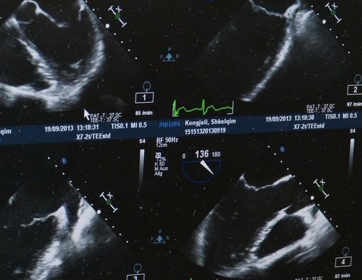Mengenal Amniotic Band Syndrome, Kondisi Janin Teramputasi dalam Kandungan