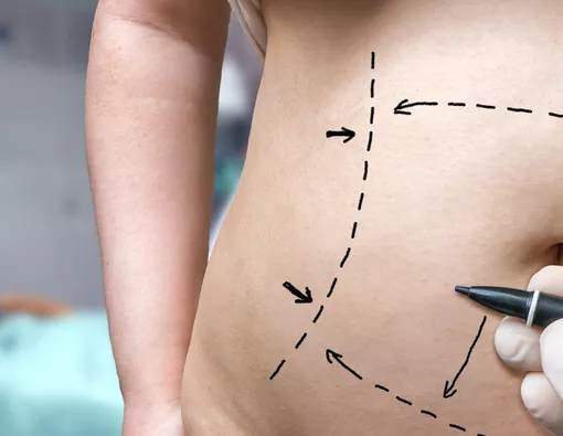 Tummy Tuck, Cara Instan Bikin Perut Rata