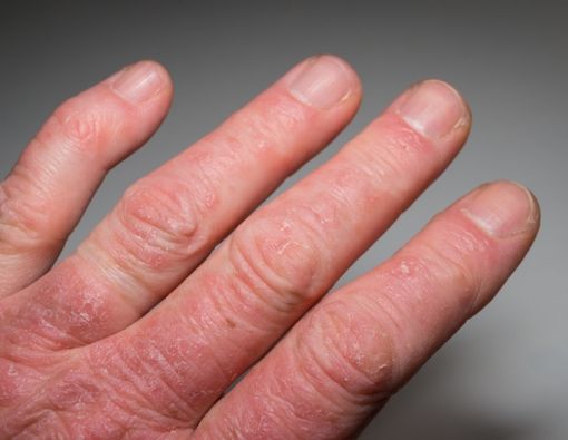 Benarkah Kondisi Psoriatic Arthritis Meningkatkan Risiko Terkena Kanker?