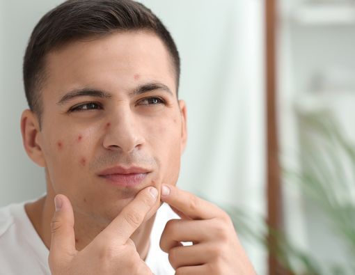 Kenali 3 Penyebab Jerawat pada Pria