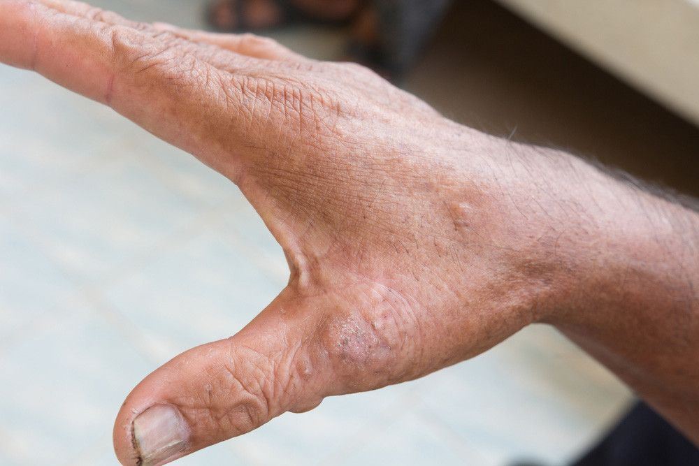 Selain Kanker Penyakit Ini Bisa Diobati Dengan Kemoterapi KlikDokter