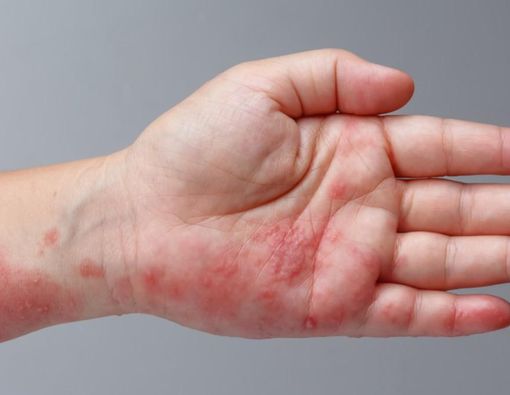 Beda Antara Herpes Zoster dan Herpes Simpleks