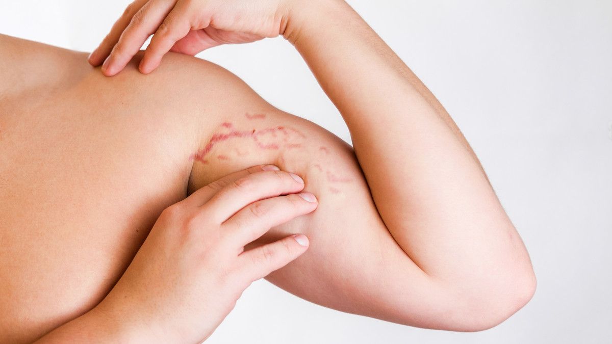 Cara Mudah Mencegah Stretch Mark