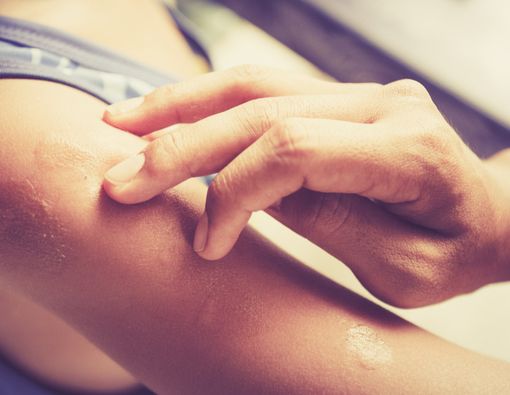 Amankah Anak Terus-menerus Menggunakan Salep untuk Atasi Alergi?