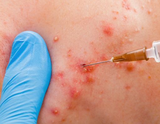 Suntik Jerawat, Amankah untuk Dilakukan?