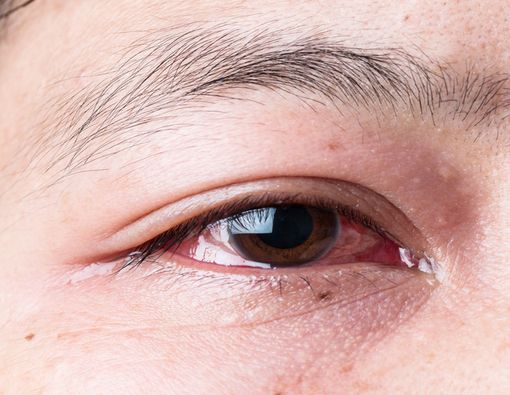 Penelitian Baru Sebut Virus Corona Berpotensi Ditularkan Lewat Mata