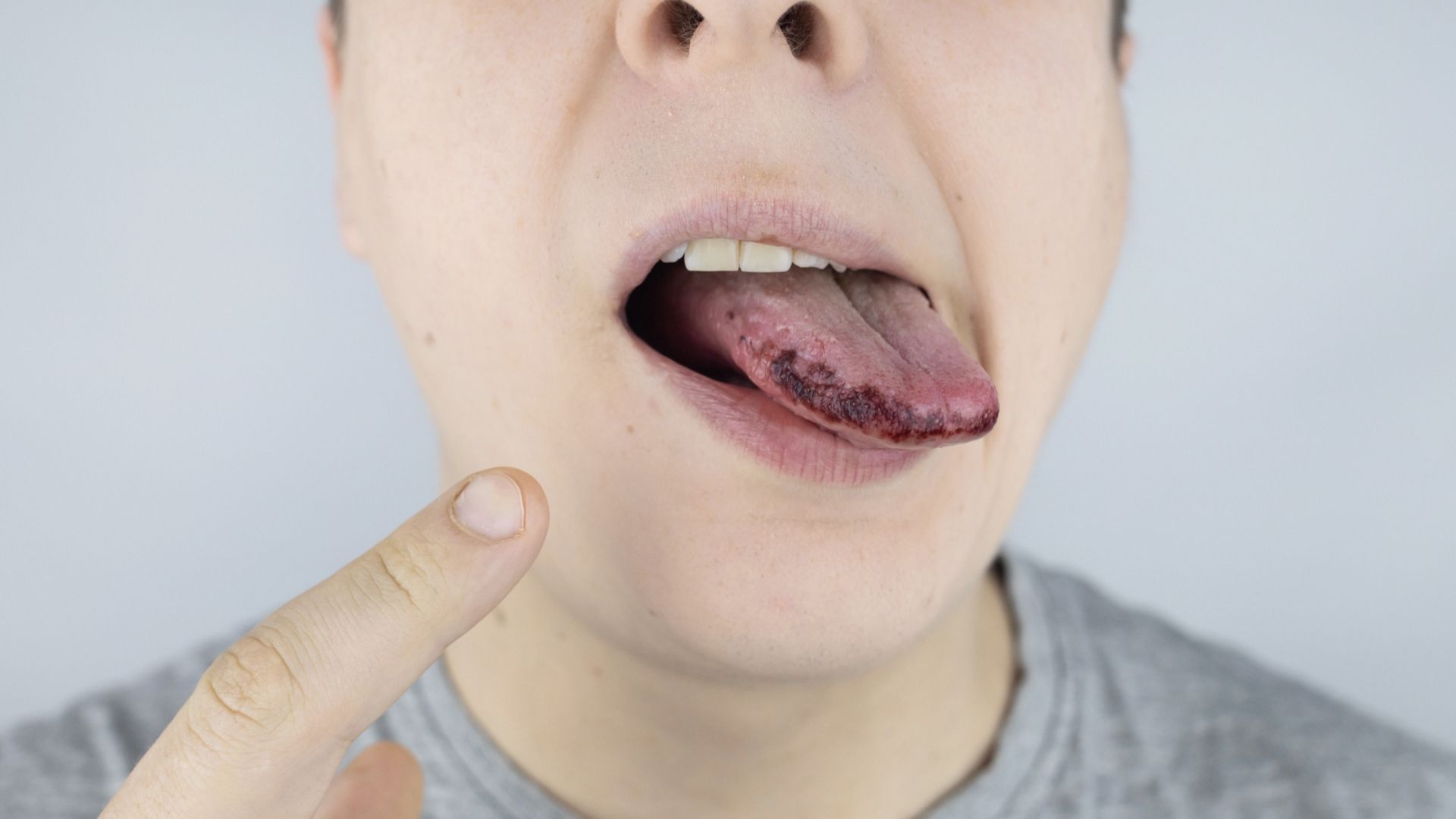 7 Penyebab Lidah Menghitam dan Berbulu, Berbahayakah?