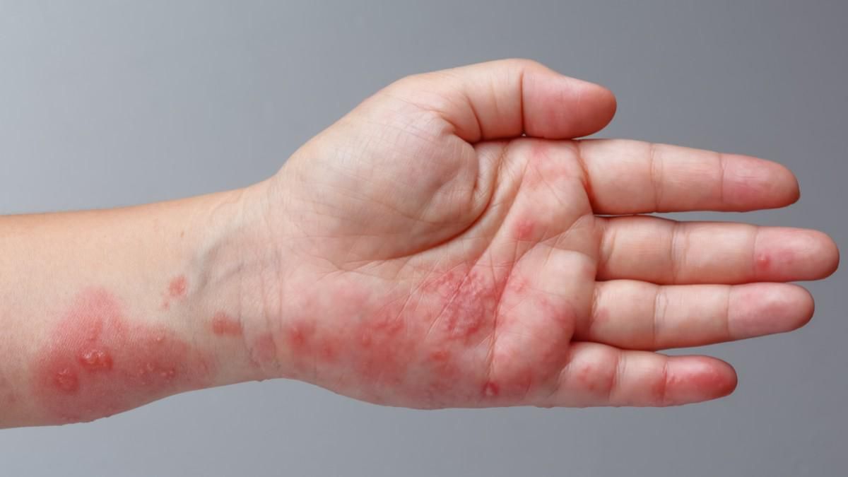 Beda Antara Herpes Zoster dan Herpes Simpleks