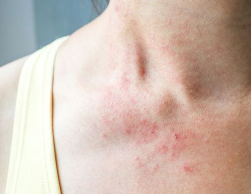 11 Jenis Kurap, Muncul di Kepala Hingga Kaki