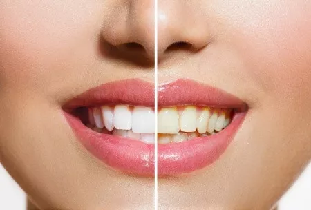 4 Cara Mudah Menjaga Gigi Putih Terawat