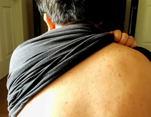 Manfaat Minyak Cengkeh untuk Menghilangkan Jerawat Punggung