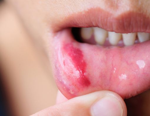 Menelan Darah dari Luka di Mulut, Berbahayakah?