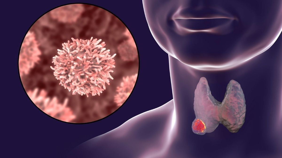 Mengenal Jenis-Jenis Pengobatan Kanker Tiroid