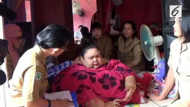Wanita 350 kg di Kalteng, Obesitas Akibat Gemar Ngemil Gorengan?