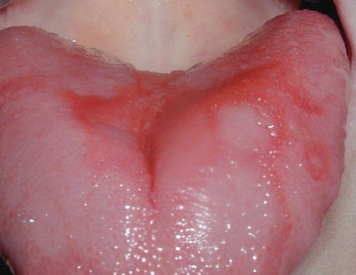Cara Mengatasi Burning Mouth Syndrome Sesuai Jenisnya