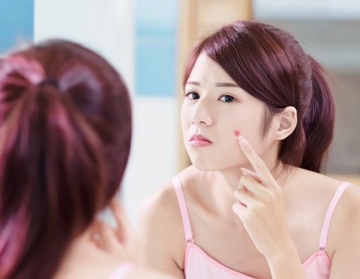 Jerawat Tak Hilang, Hati-hati Kondisi Hiperandrogen!