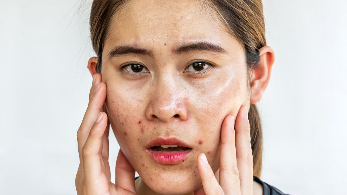 Terapi Topikal untuk Mengatasi Jerawat 