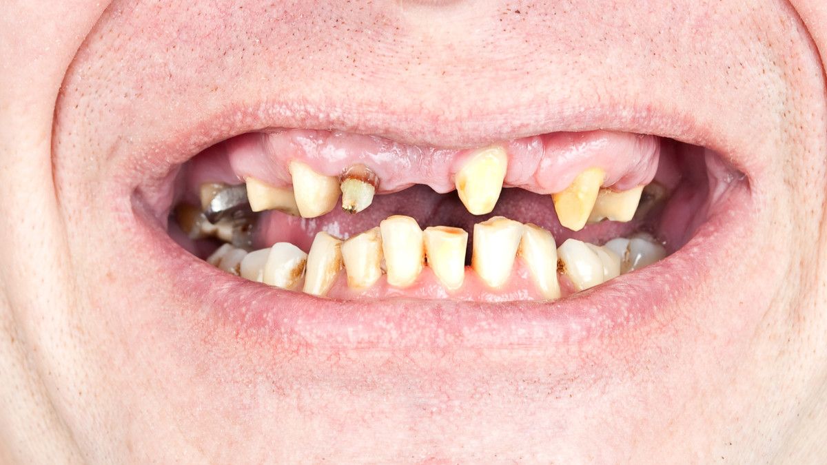 Masalah Kesehatan Gigi yang Sering Dialami Pengguna Narkoba