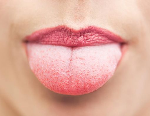 Lidah Berwarna Putih, Apa Sebabnya?