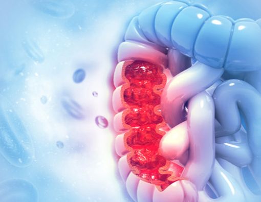 Vitamin D Bisa Bantu Melawan Kanker Usus Besar?