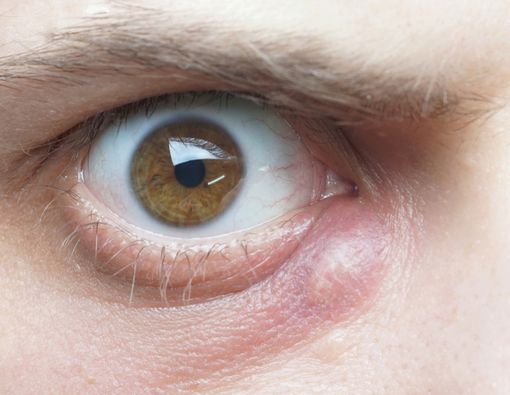 Mengatasi Mata Bintitan dengan Cara Mudah Ini