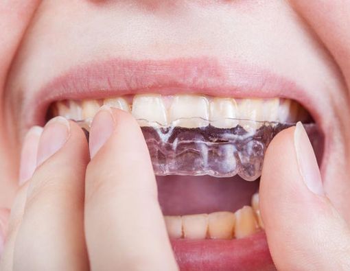 Suka Menggertakkan Gigi saat Tidur? Coba Pakai Pelindung Gigi