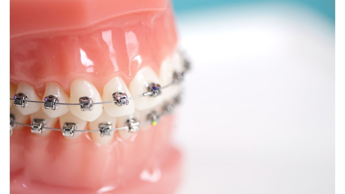 Cara Menjaga Kebersihan Kawat Gigi