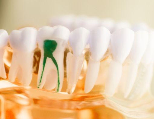 Ketahui Penyebab Short Root Anomaly atau Akar Gigi Pendek