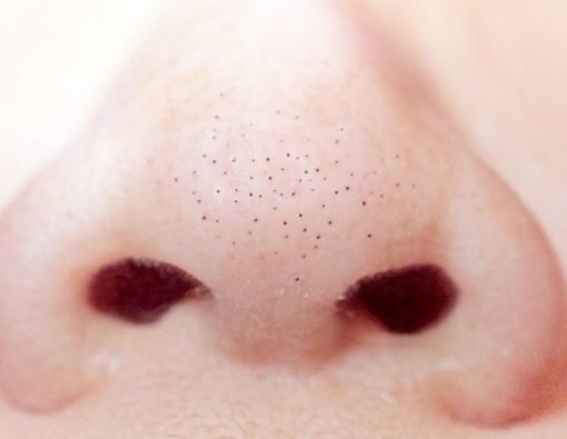 Pori-Pori Besar Vs Kecil, Mana yang Lebih Rentan Berkomedo?