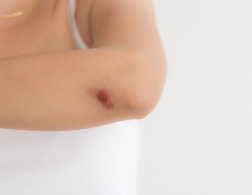 Bekas Luka Menonjol Tak Selalu Keloid