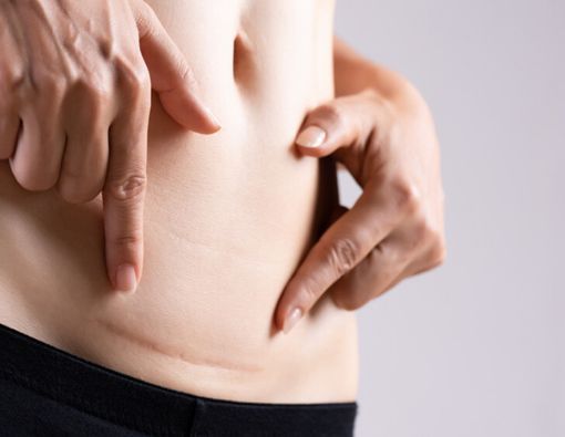 7 Tips agar Luka Operasi Caesar Cepat Kering