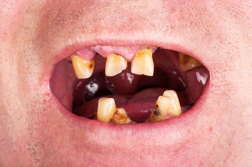 Pria Ini Tidak Gosok Gigi Selama 20 Tahun, Ini Akibatnya