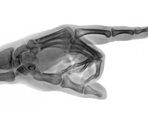 Mengenal Jenis-Jenis Kanker Tulang