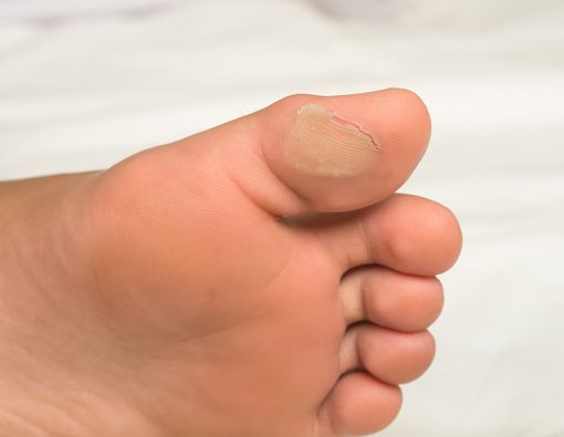 Kaki Melepuh di Cuaca Panas Saat Ibadah Haji