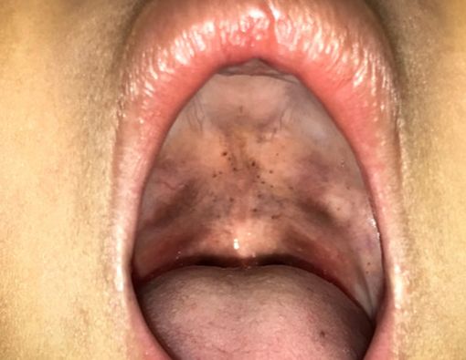 Ini 4 Alasan Mengapa Difteri Bisa Mengancam Nyawa