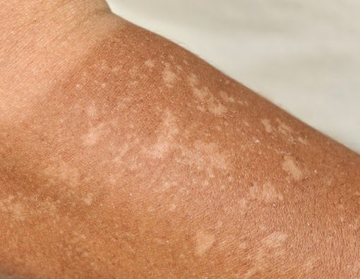 Kenali Beda Reaksi Alergi Sinar Matahari dan Kulit Terbakar Matahari