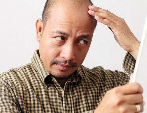 Stres Sebabkan Kebotakan