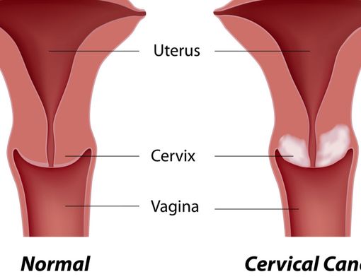 Mengenal Kanker Serviks Stadium 0