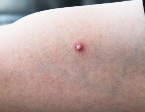 Jangan Sepelekan Bisul pada Penderita Diabetes