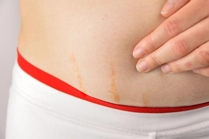 Perhatikan Ini Jika Ingin Hilangkan Stretch Mark
