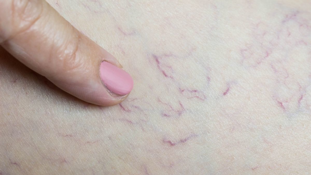 Cara Atasi Spider Vein, Pembuluh Darah Pecah di Wajah