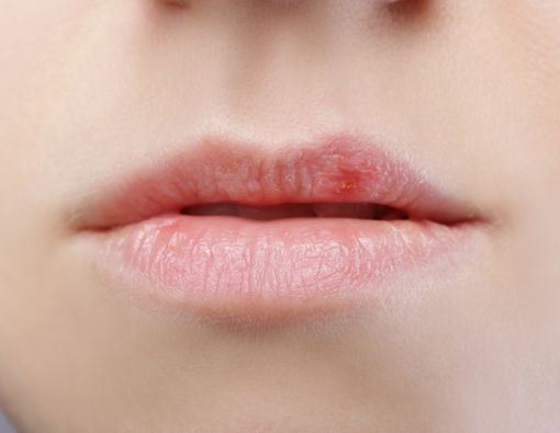 Kuku dan Bibir Pucat, Awas Gangguan Paru