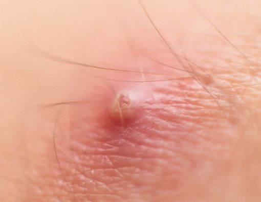 Penasaran, Benarkah Ada Makanan yang Picu Bisul?