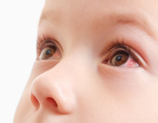Mengatasi Sakit Mata pada Balita